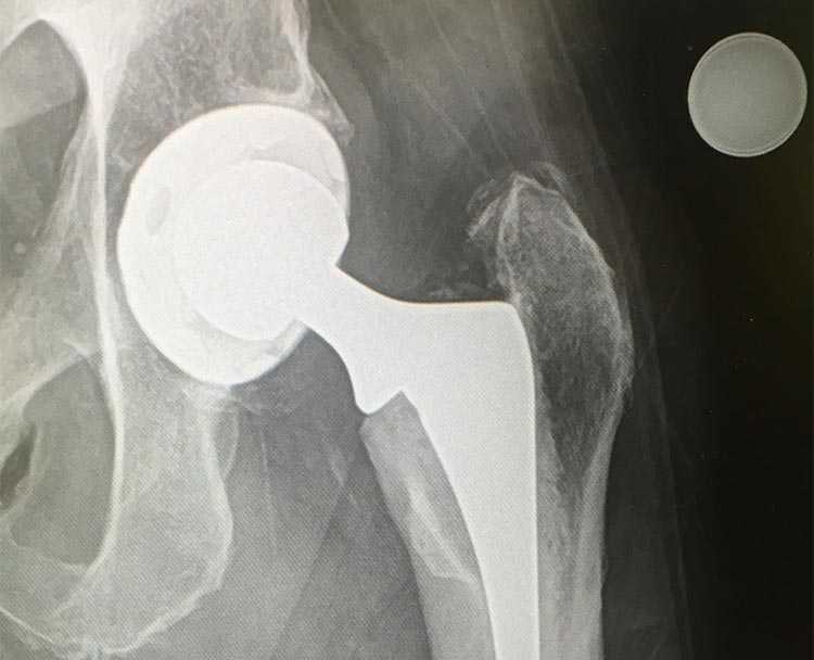 knee xray image